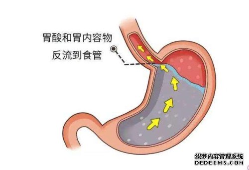 胃食管反流要如何治疗