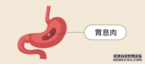 引发胃息肉的原因